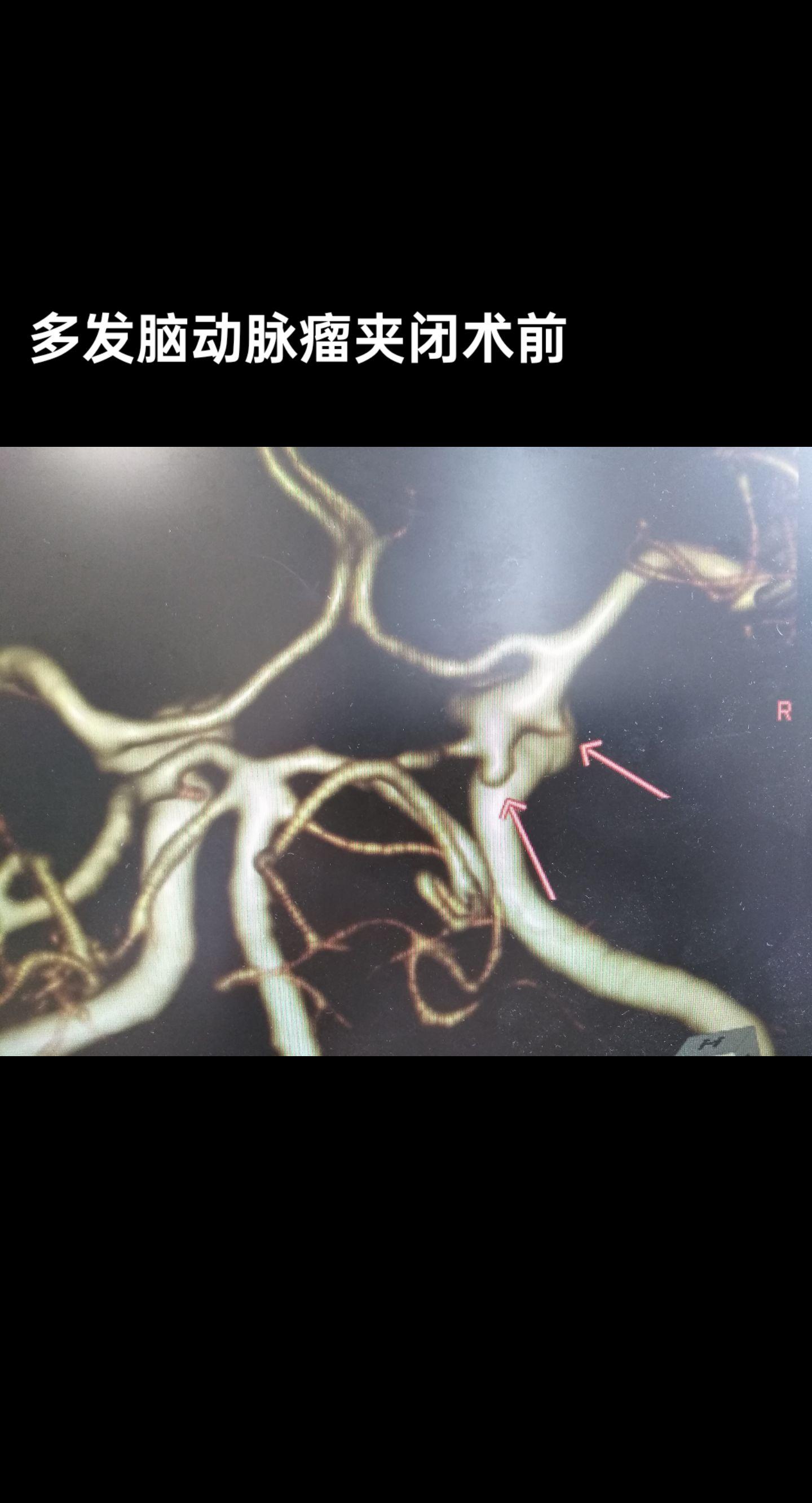手术室日常 医者仁心 医路前行 血管 显微镜下的世界
