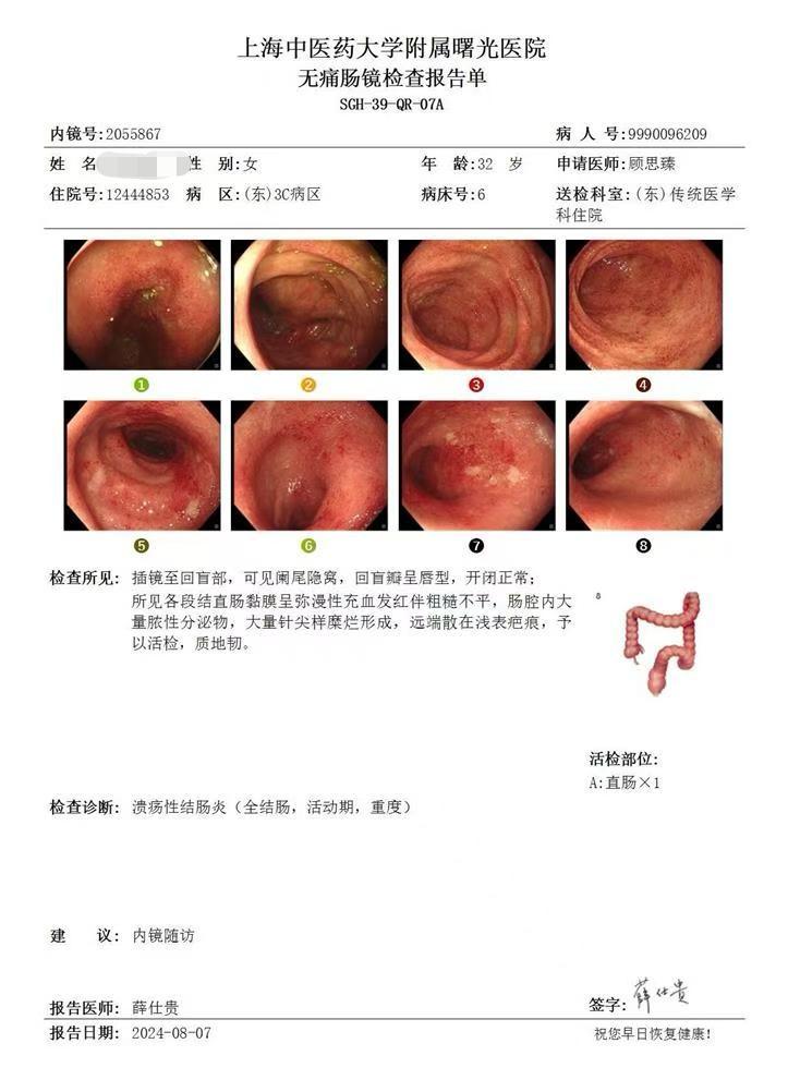 溃疡性结肠炎患者的肠镜是“医从性”测慌仪。 两位都是便血为主的全结肠的...
