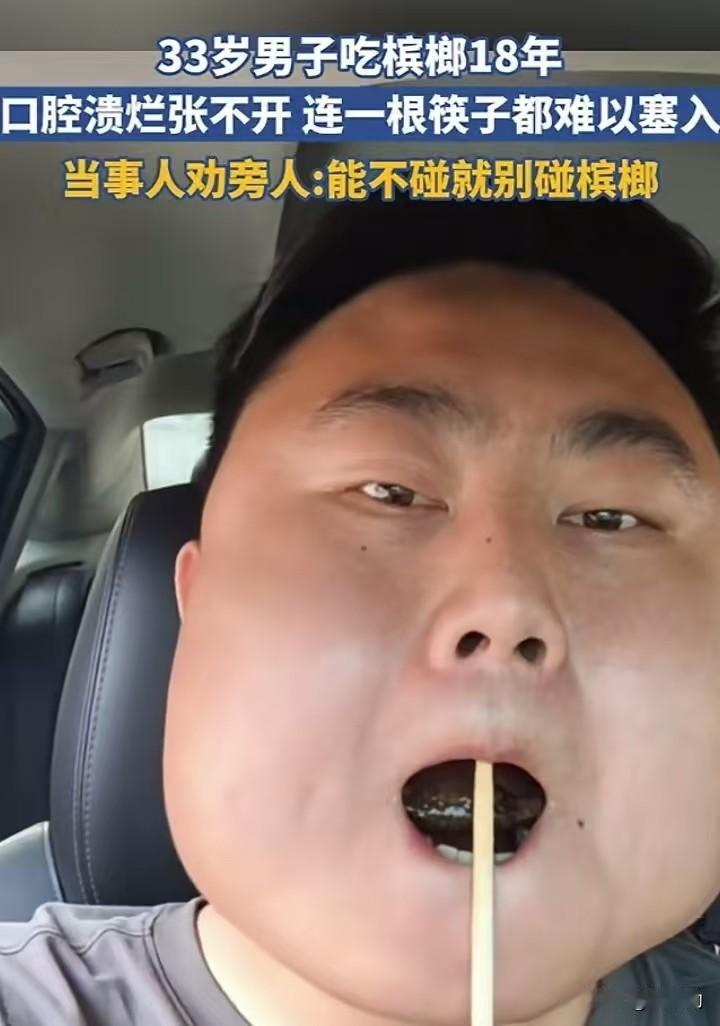 33岁男子连续嚼食槟榔长达18年，如今口腔严重溃烂，张口困难到仅能勉强塞进一根筷