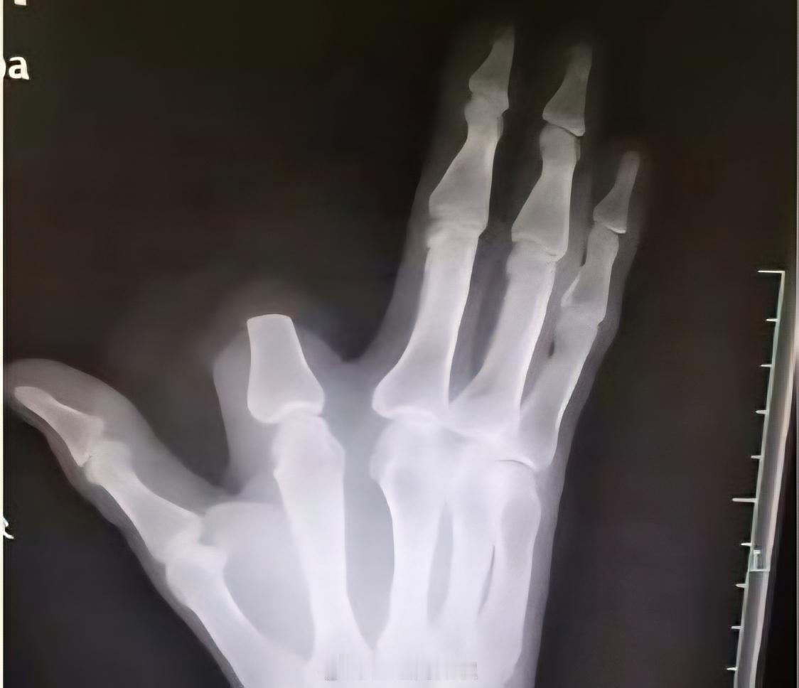 男子被蛇咬伤后砍掉自己的手指，以防止毒液扩散。到了医院医生说这不是毒蛇。不过即使