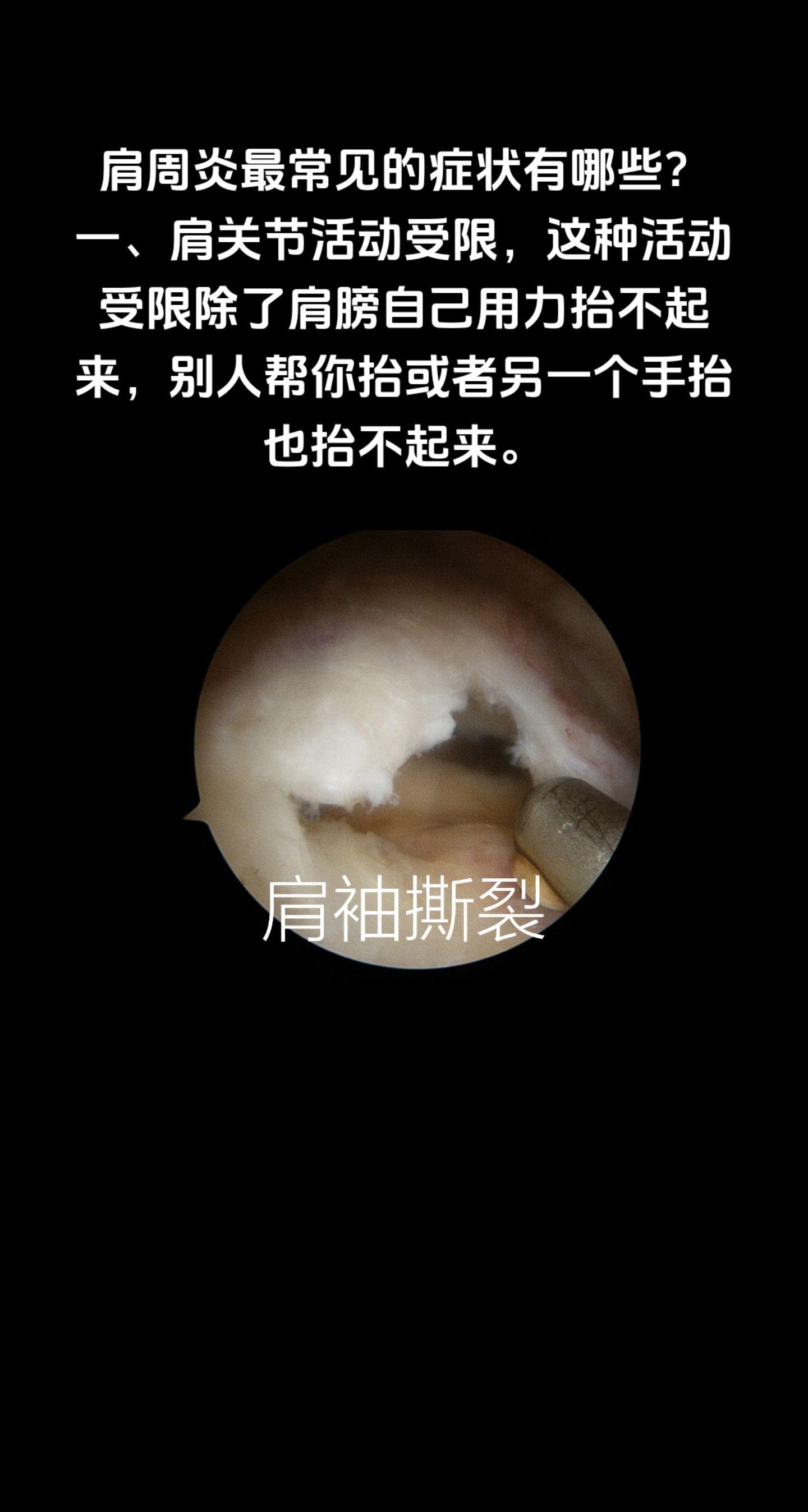 肩周炎最常见的症状有哪些？