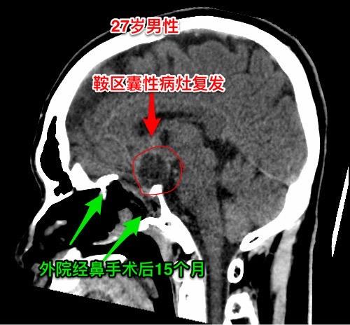 第一次经鼻手术后诊断为颅咽管瘤，可靠吗？27岁广西壮族自治区人，自幼视...