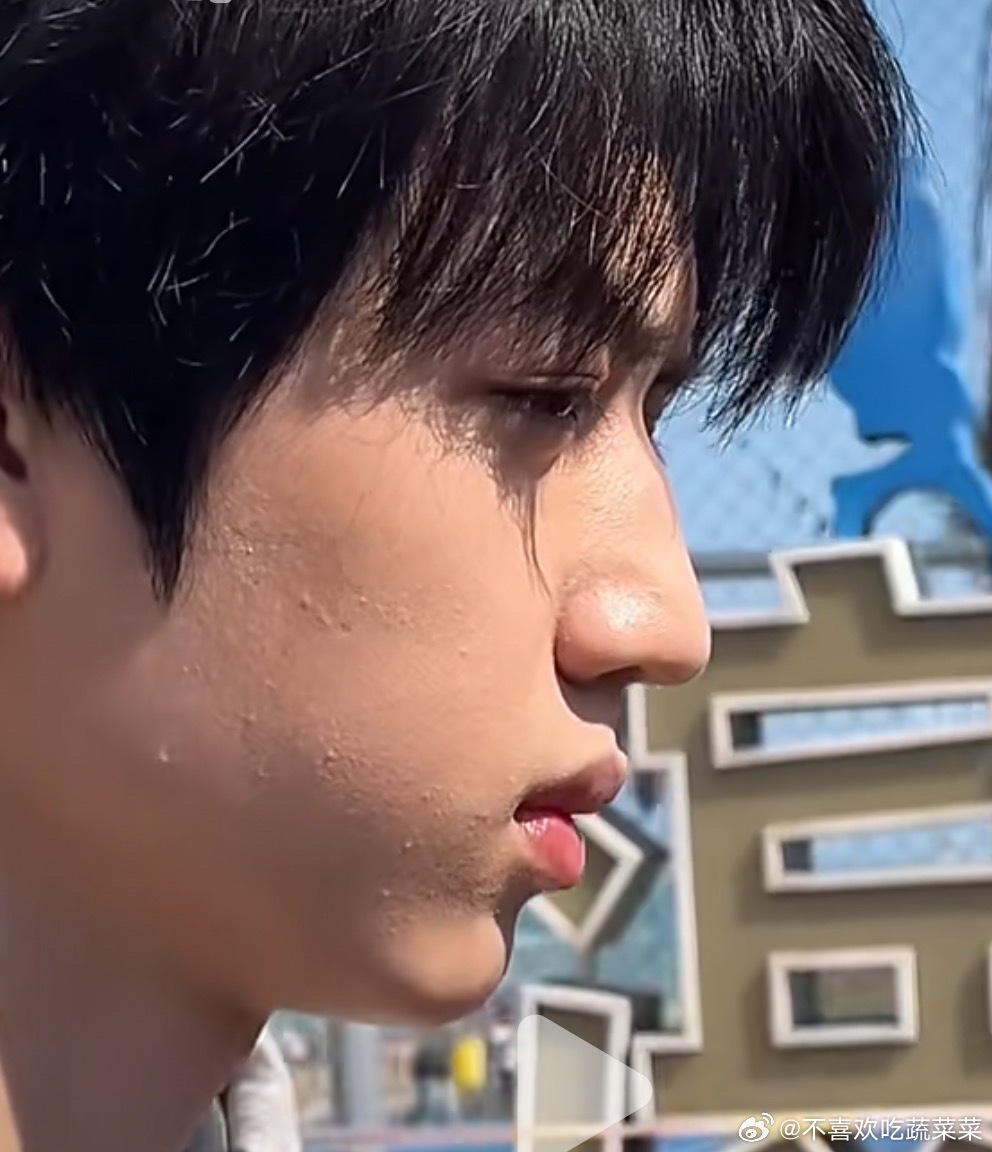 tg张桂源杨博文脸上长痘痘了 