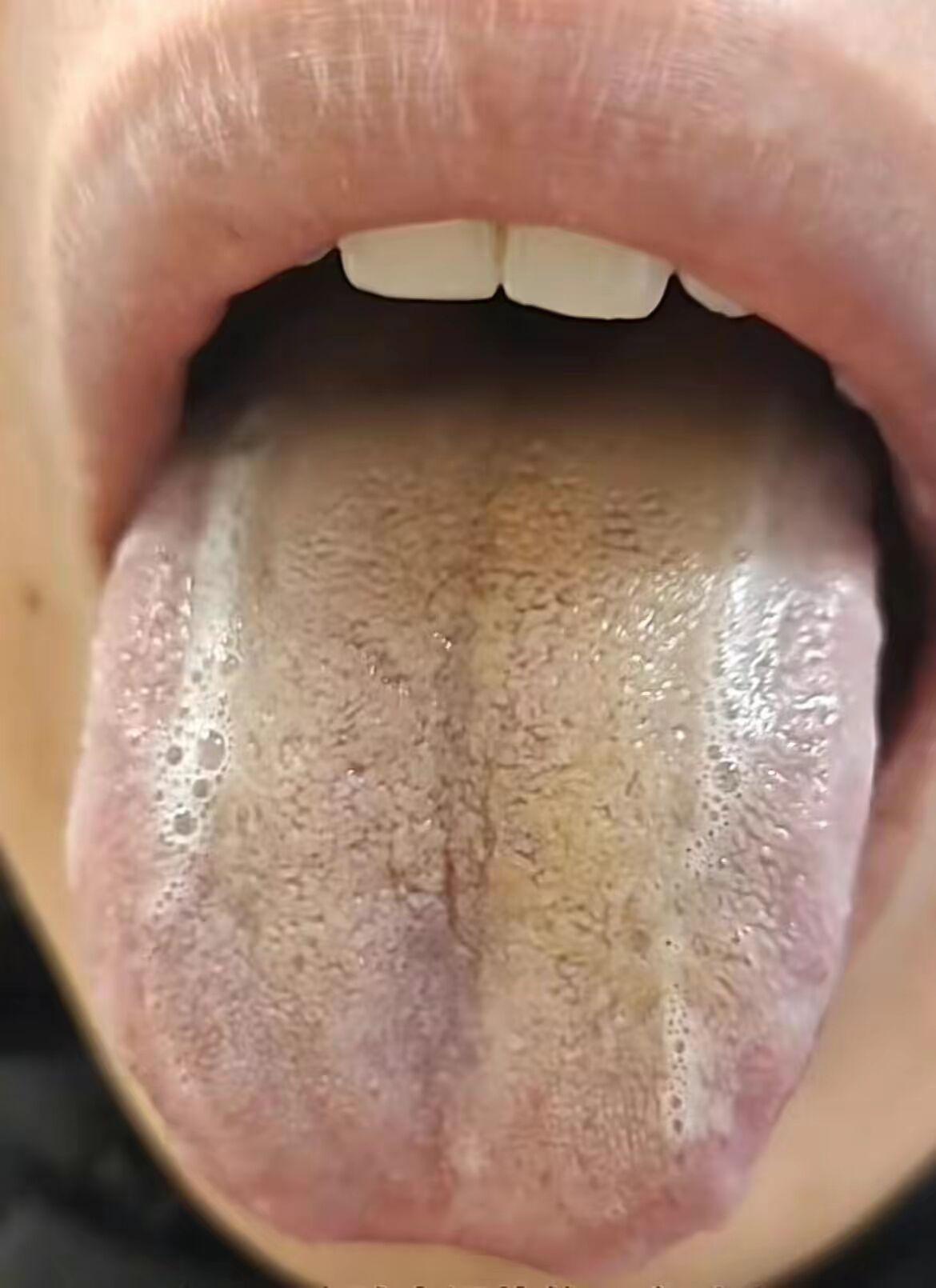 针对舌象分析，单纯清热利湿是治标不治本！
患者描述：情绪不稳定，能力下降，思维消