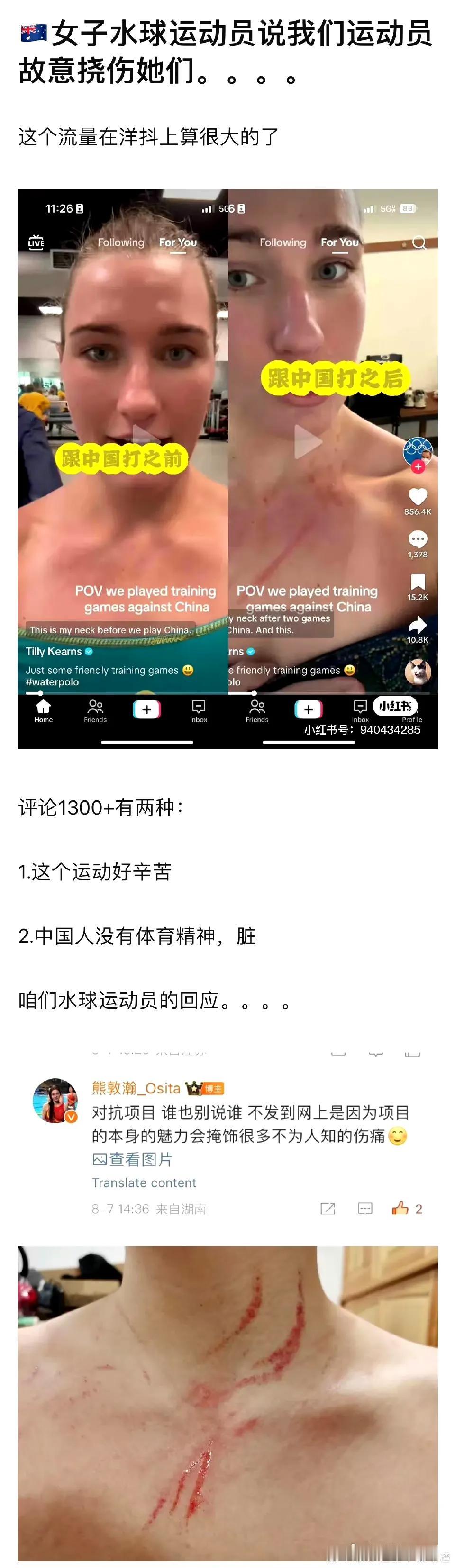 澳洲水球运动员说咱们运动员故意挠伤她们，咱们水球运动员熊敦瀚回应并晒了照片。  