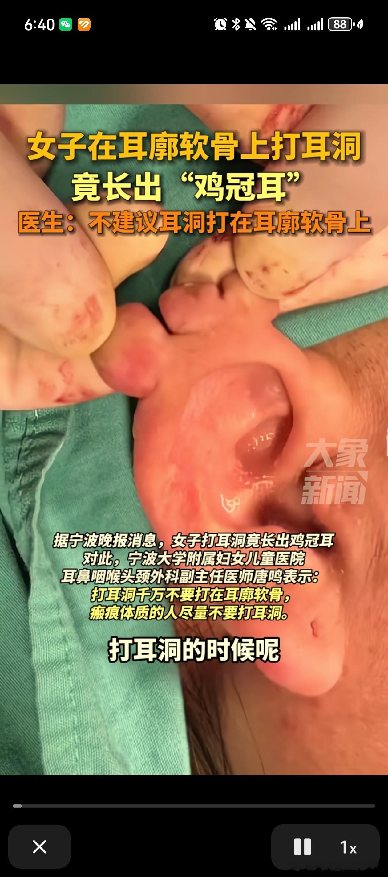 美役的危害 打耳洞会长出“鸡冠耳” 