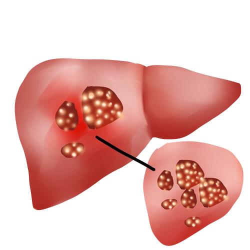 肝癌早筛，这2项检查比CT更实用！很多人白花钱还漏诊

每天门诊都能遇到肝癌中晚