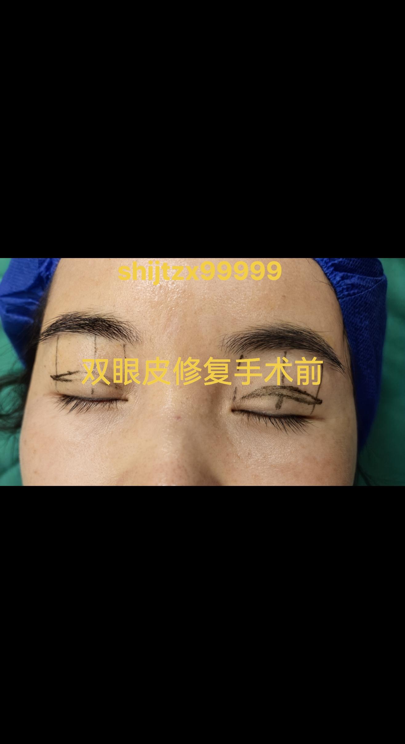 整形美容术前设计划线很重要。