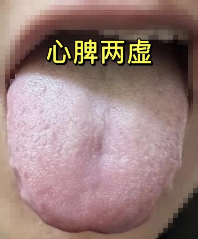 下焦湿热的舌象、症状、成因和调理方向完全对应，四妙丸也正是针对这类证型的核心方剂