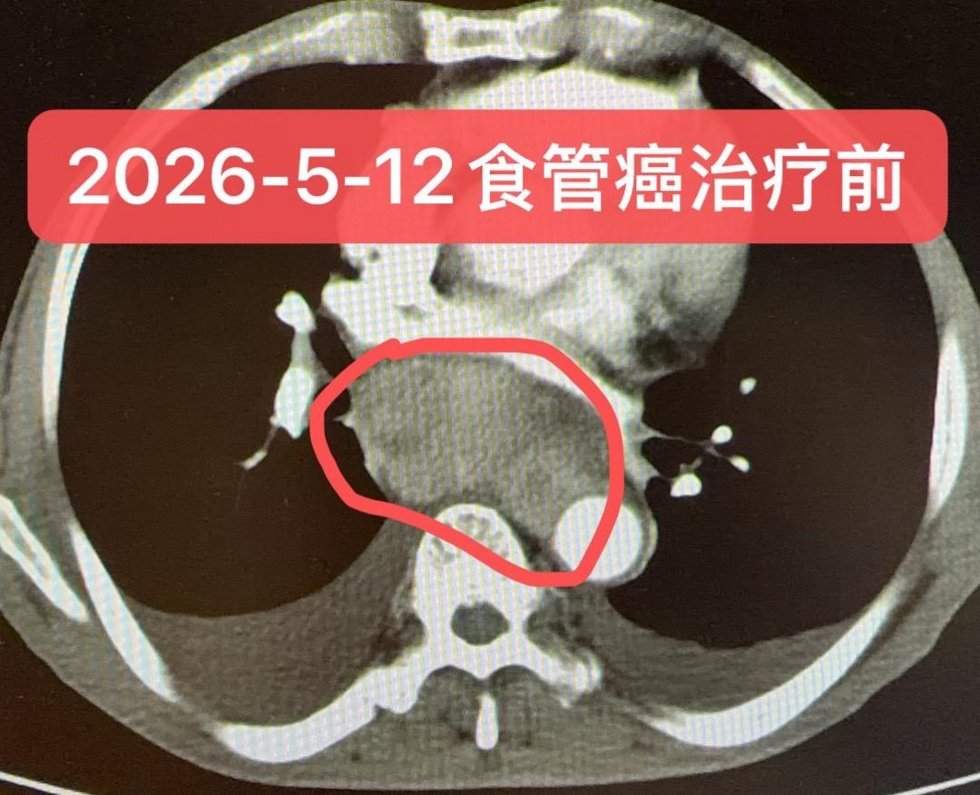 巨大食管癌的治疗一例。男性，77岁，基线诊断为食管鳞癌IV期（2026...
