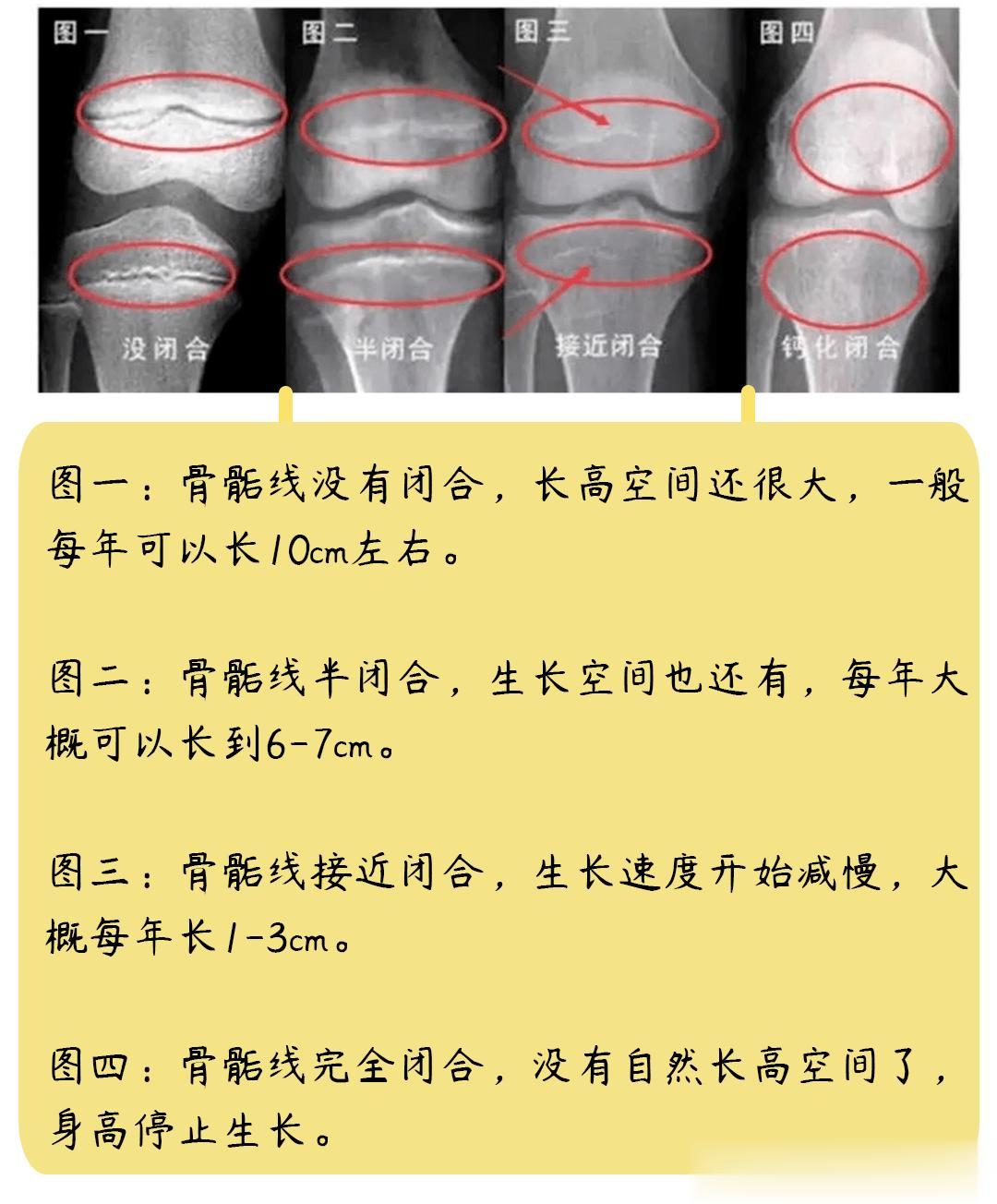 简单三步判断孩子的骨骺线是否闭合
 
家长们及时发现，尽快补救，孩子还有机会再蹿