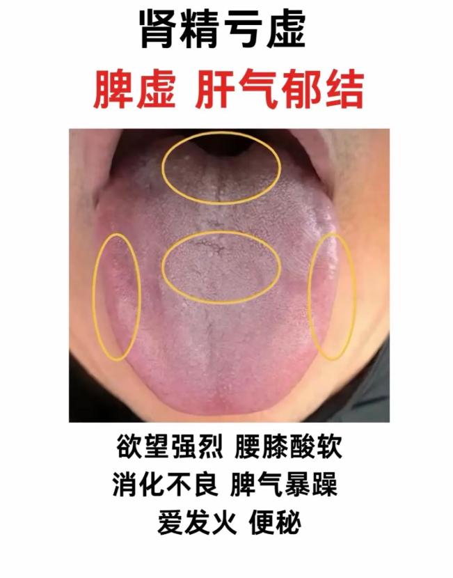 肾精亏虚、湿热下注、肾气不足，看舌头就知道你是哪一种