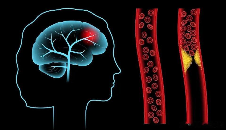 血栓来临，手脚先知？提醒：手脚若出现4种异常，或许血栓已来临1、手脚发冷：当血栓