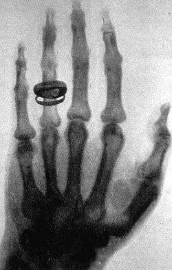 带戒指的手 (Hand mit Ringen) 人体部位的第一张 X 射线照片，