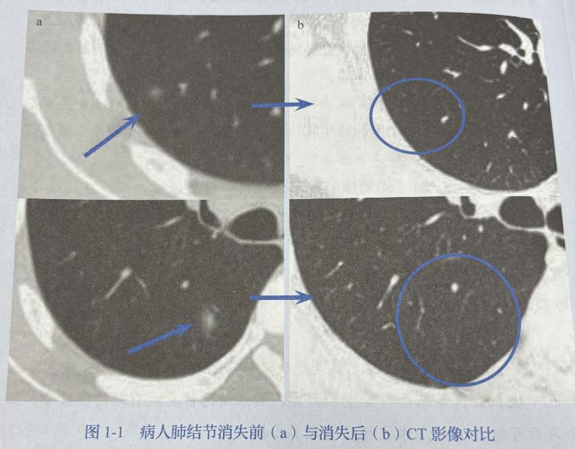 很多朋友一发现肺磨玻璃结节，心里就特别着急。甚至有些看了医生说：“你这个结节有点