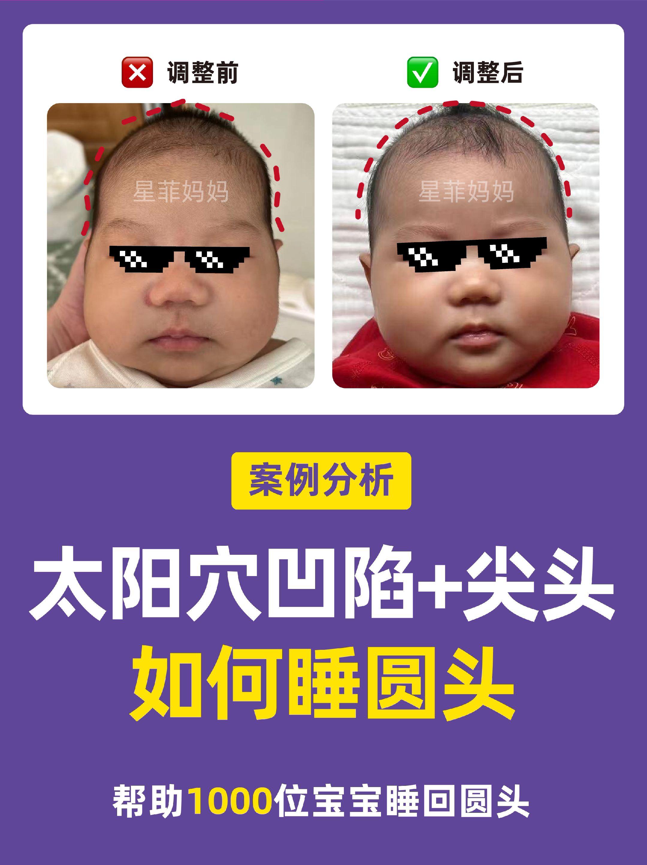 太阳穴凹陷+尖头调整方法。