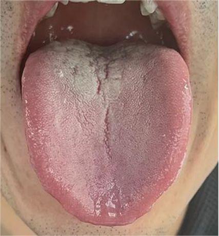 心火旺盛湿气重，舌象调理有妙招！
这舌头极具代表性，看似调理困难，但实际上问题并