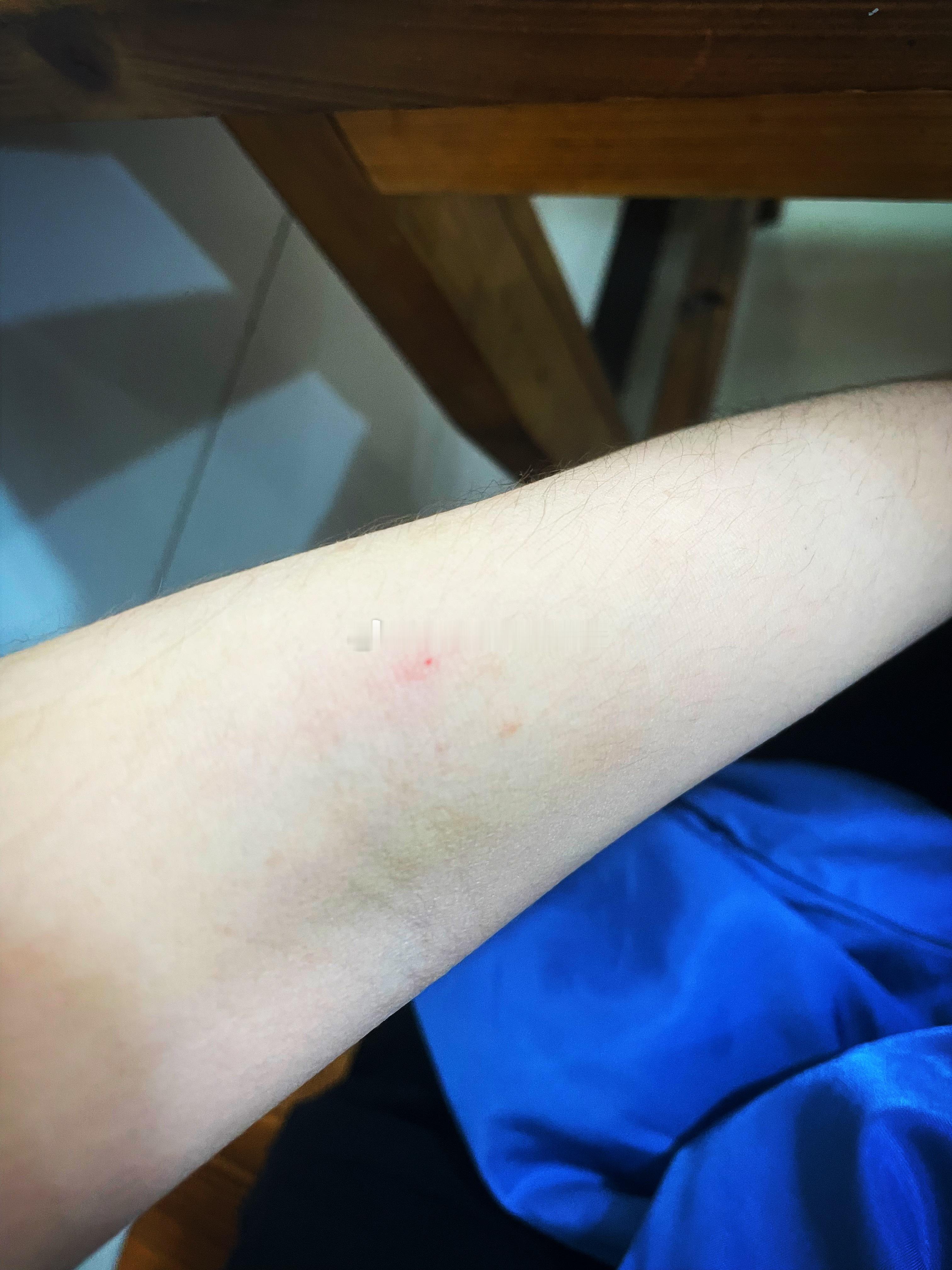 抽血完毕今天左侧手臂抬不起来了上方还有伤口未痊愈下方又是新的这个月别想着长肉了倪