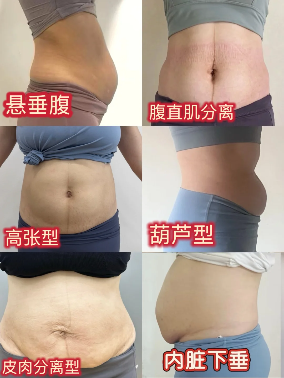 你是哪种腹型|附解决思路
