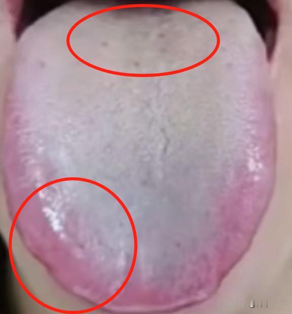 你看这舌边红的，这体内的火可不小，有这样的舌象，男科再差劲也不能去补肾

主诉：