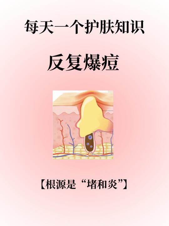 每天一个护肤知识：反复爆痘