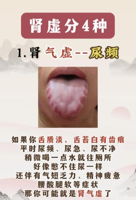 中医讲肾虚：原来分这 4 种类型