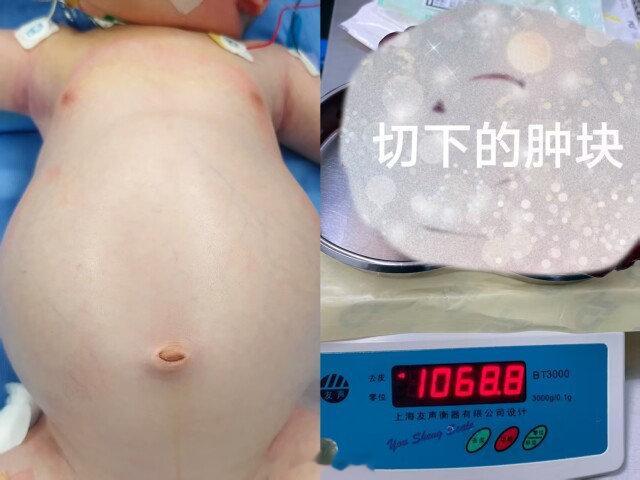 【 新生儿肚中取出2斤重肿瘤 ！ 专家提醒小儿腹腔肿瘤早期缺乏典型症状 】你敢想