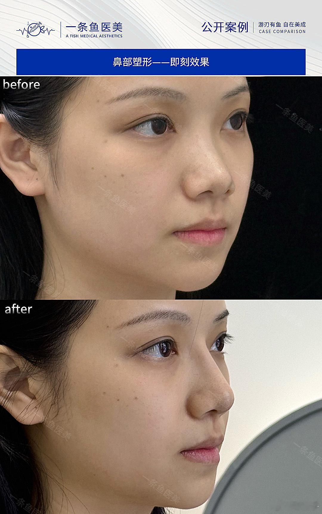琳波医美 我的美女客户 效果太好 同样一只caha 