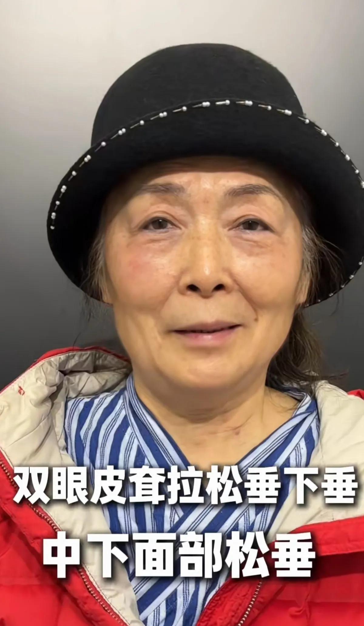 年近70岁的女人了，还在为年轻美貌而折腾自己，做了脸部和双眼皮拉皮，双眼皮拉皮后