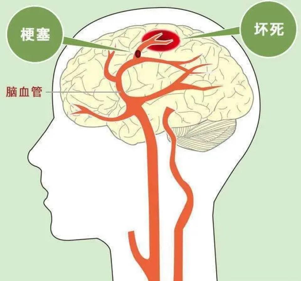 脑血栓前兆，注意身体发出的6个信号，知道这些科学预防可救命!​​1、哈欠不断​​