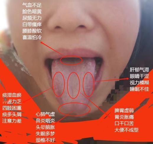 今日份患者舌象分析案例#中医健康##健康养生##舌象分析#