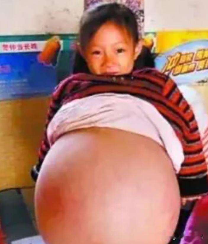 山西一四岁小女孩，因肚子鼓得像孕妇一样大成了村里的 “特殊存在”。医生断言最多撑