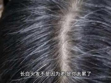 3～7天白发就能变黑？这是真的吗？
 
刷到一个热搜，真的太让人意外了。
 
有