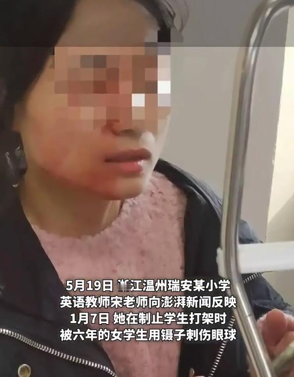被戳伤眼球女教师希望处分涉事女生，根据报道，浙江温州某小学的宋老师，因制止男女生