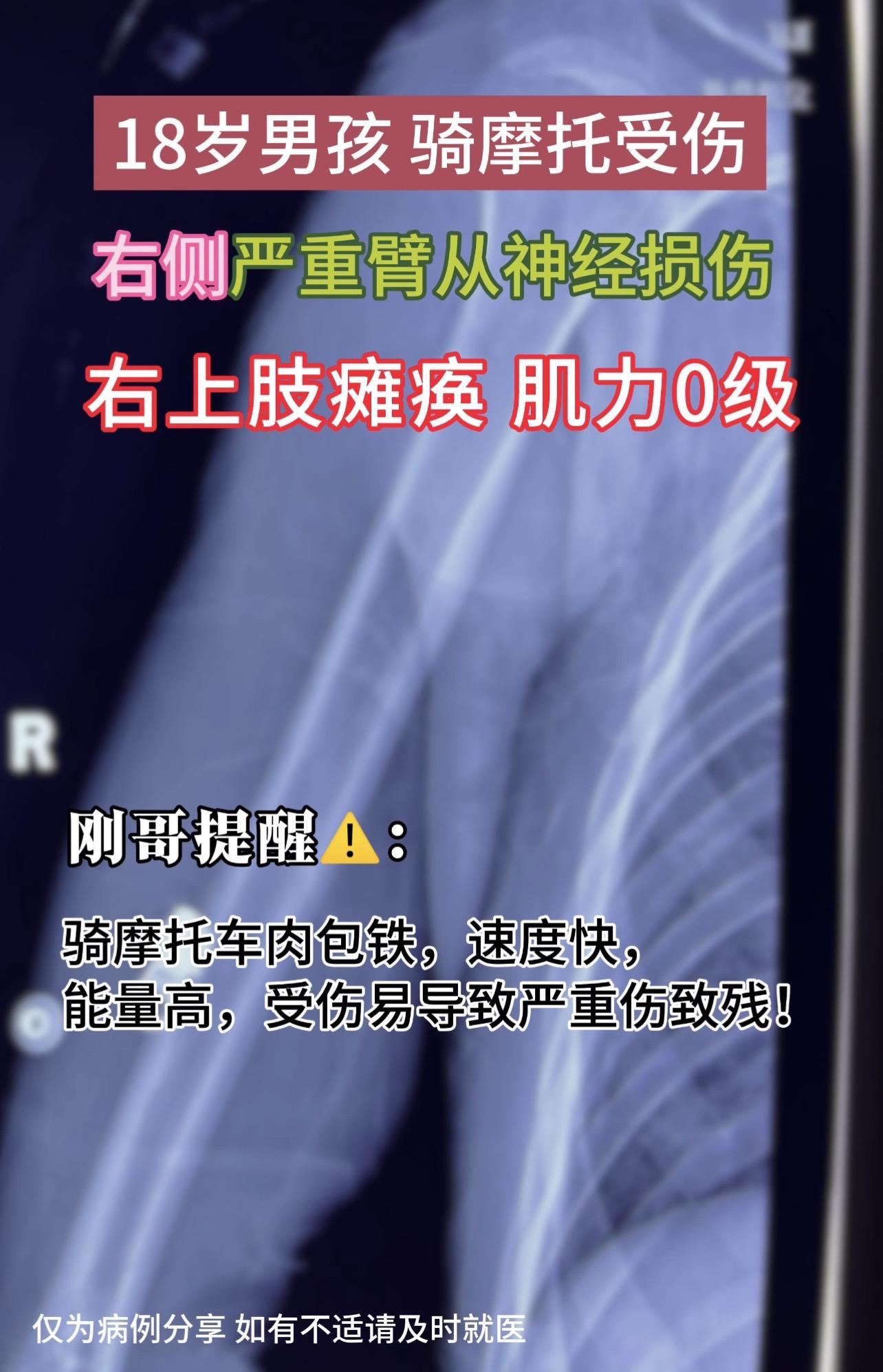 门诊碰到一18岁小伙子，骑摩托车受伤，右侧严重臂从神经损伤，右上肢瘫痪...