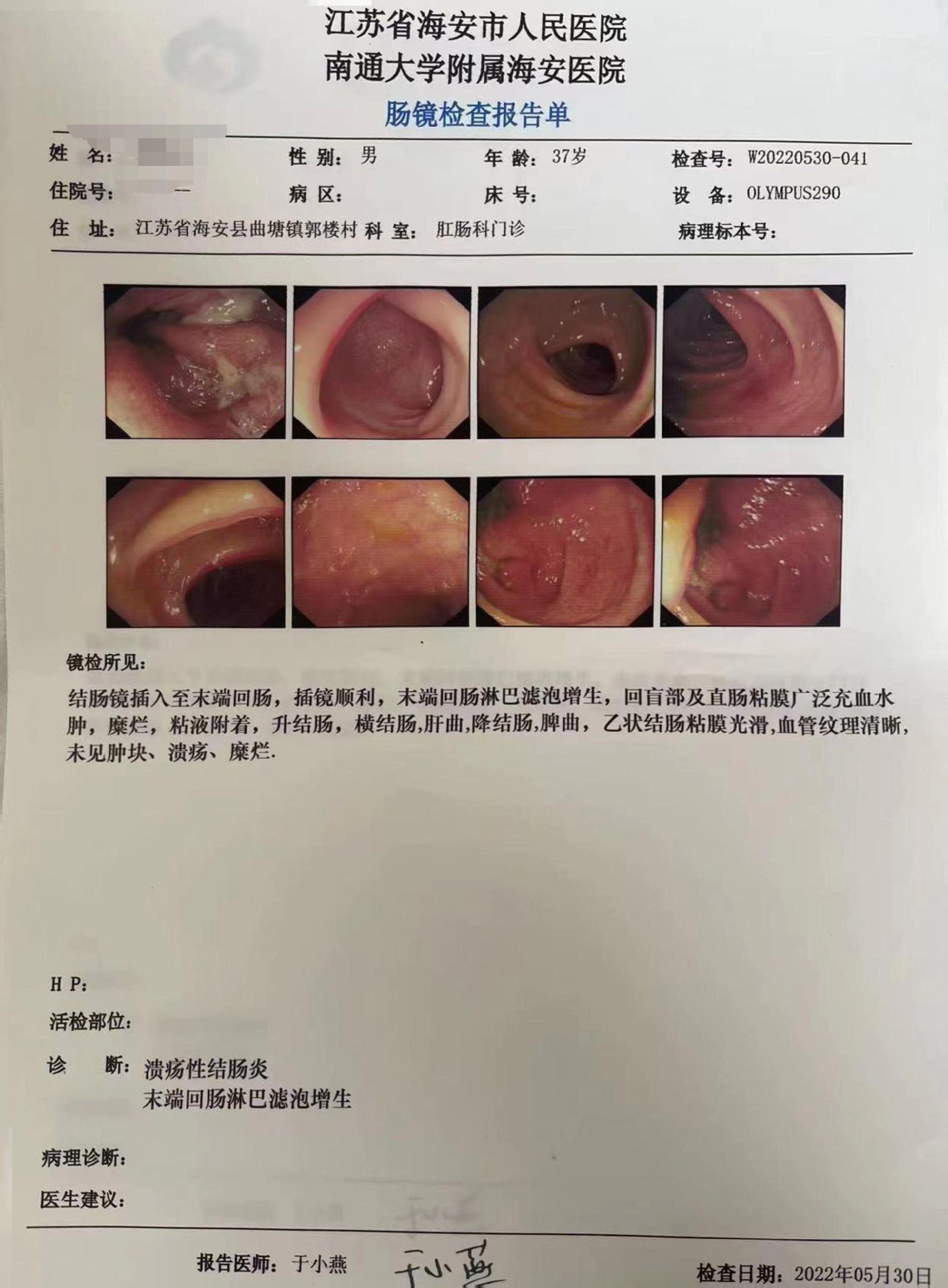 患者很好地践行溃疡性结肠炎达标治疗！ 患者，3年，直肠乙状结肠中度溃结...