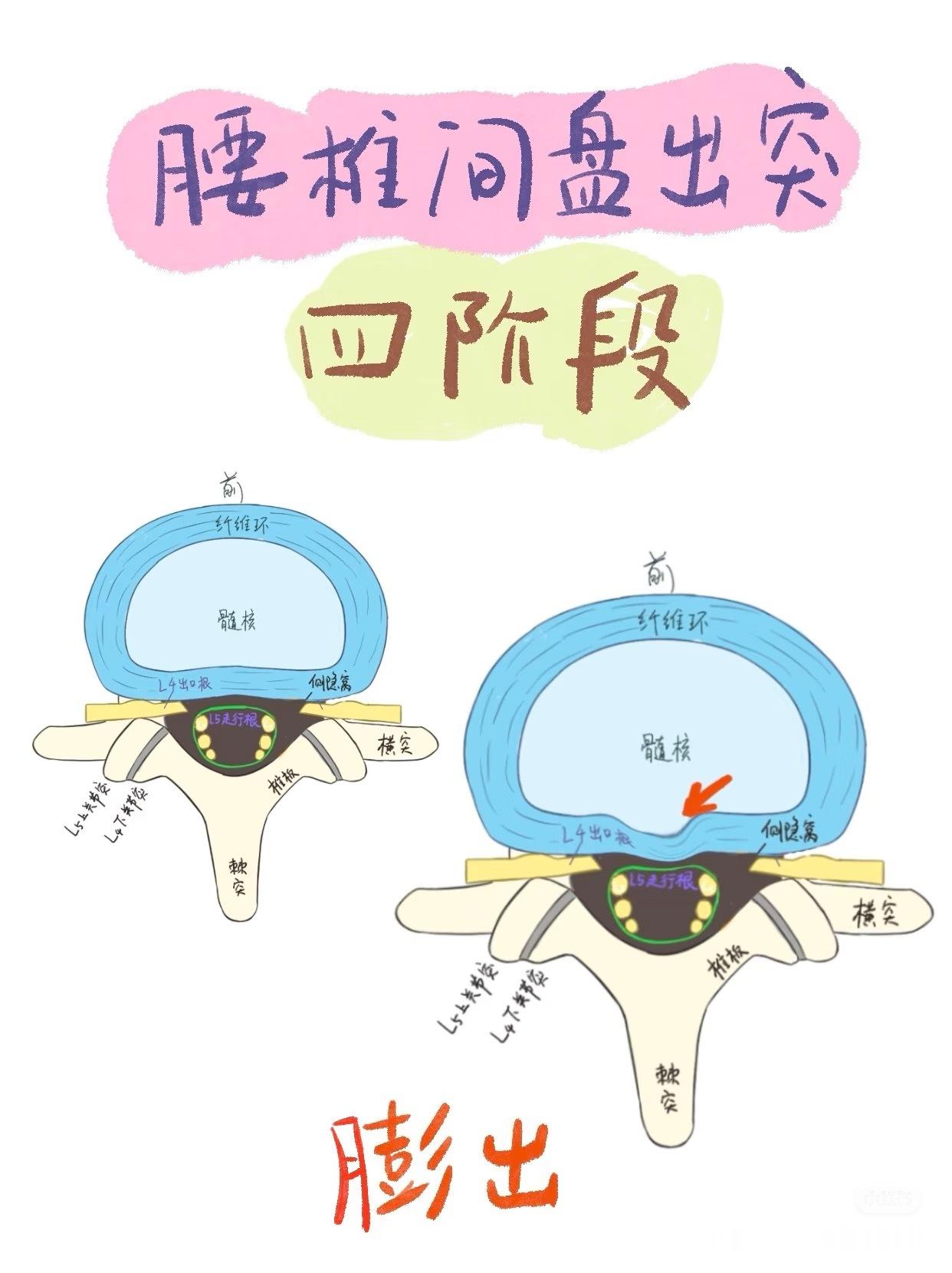 每日康复科普 【腰突康复】今天接着科普——腰椎间盘突出由轻到重的四个阶段：【膨出