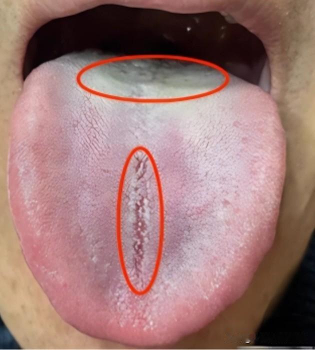 明明是肾虚舌，为什么吃补肾药没用？

患者主诉：今年40岁，每天都会用手把玩，长