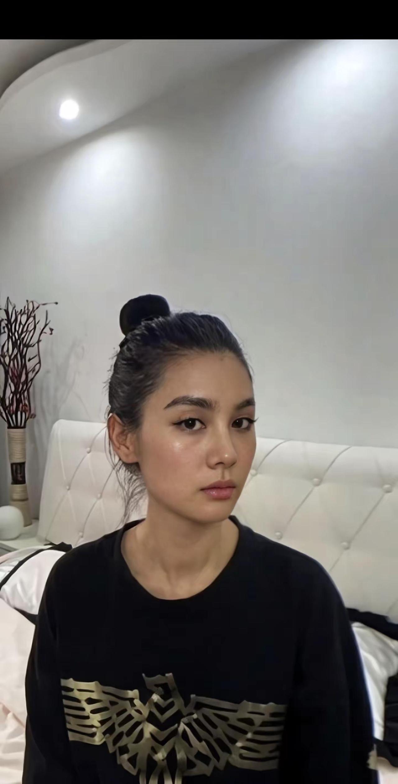 花了五个W的面部提升直接年轻到二十岁