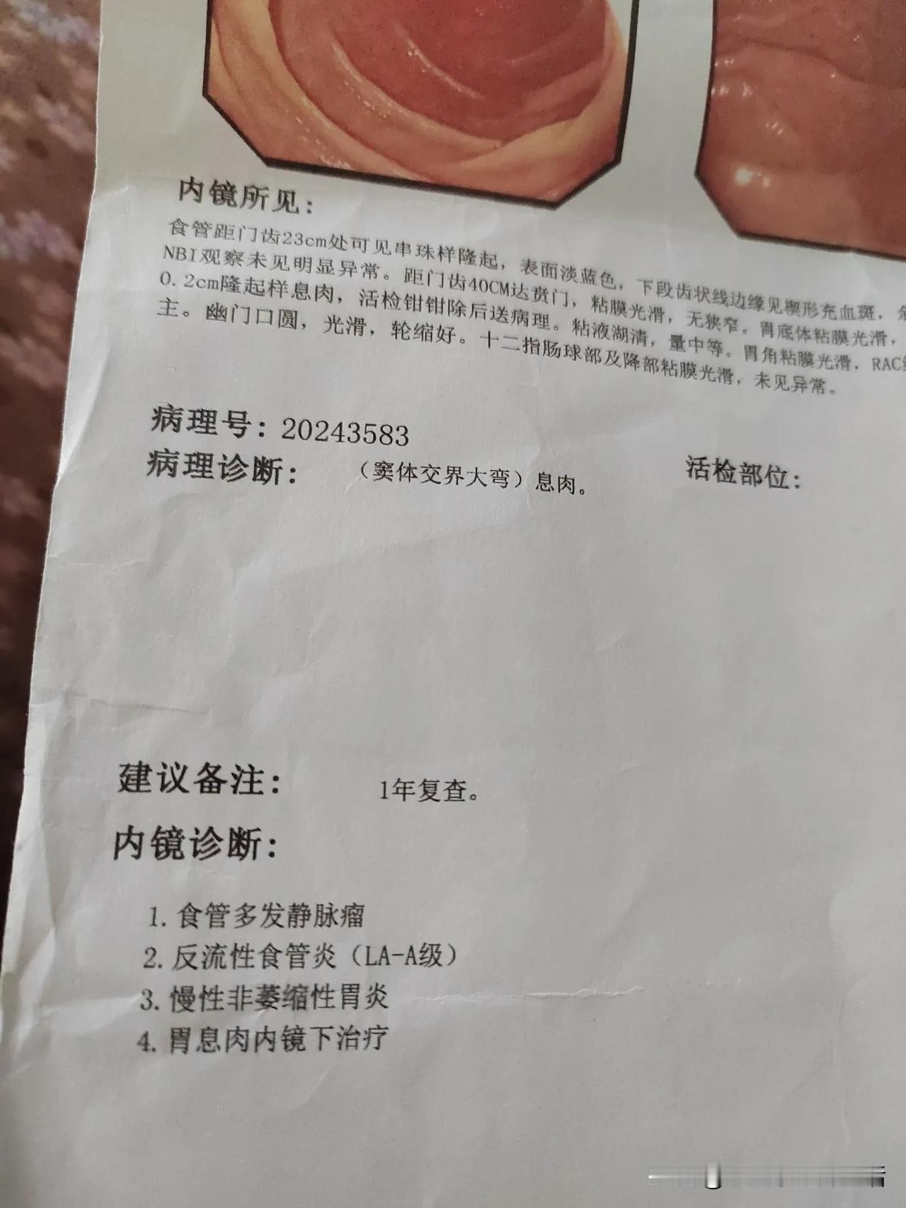 胃食管反流的我反反复复简直没法活了。总是嗓子不舒服，吃了奥美拉唑，铝碳酸咀嚼片，