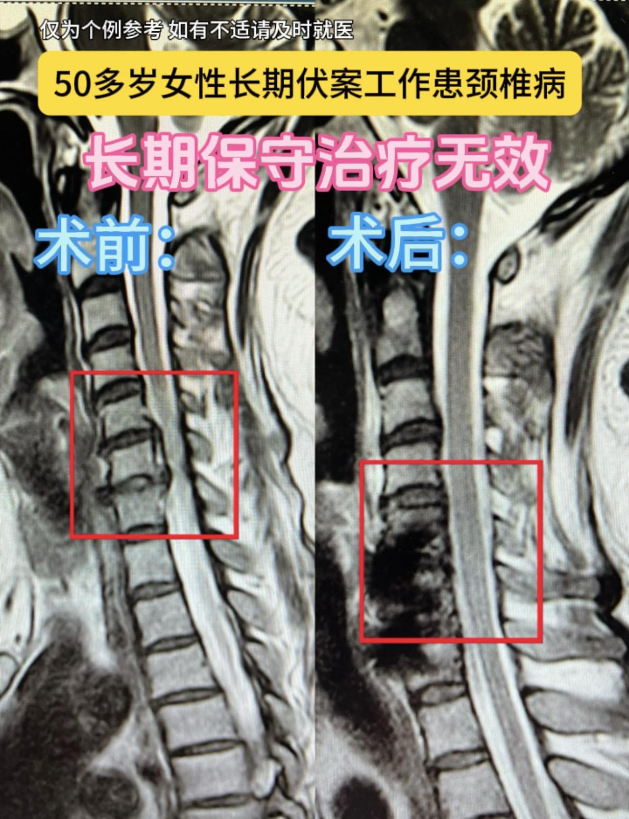 50多岁女性，长期伏案工作导致颈椎病，左肩左上肢疼痛，严重影响睡眠，长时间保守治疗无效。采用前路微创治疗，术后复查磁共振，压迫解除，症状明显缓解。