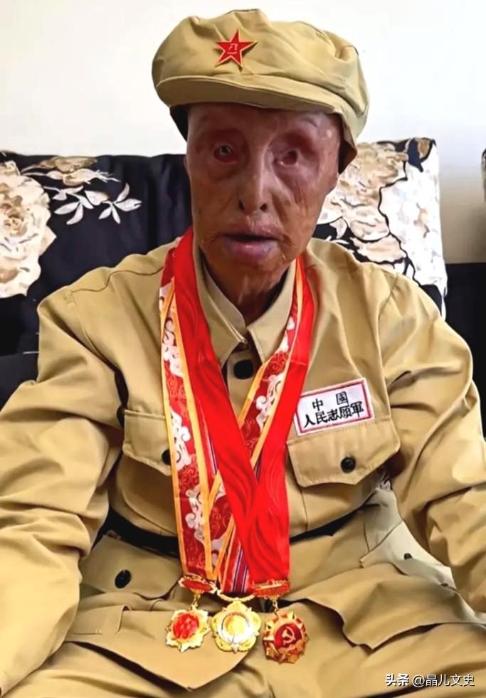 左眼被炸瞎、全身重度烧伤、十指伤残、容颜尽毁，这位满身伤痕的老人，是用命换来我们