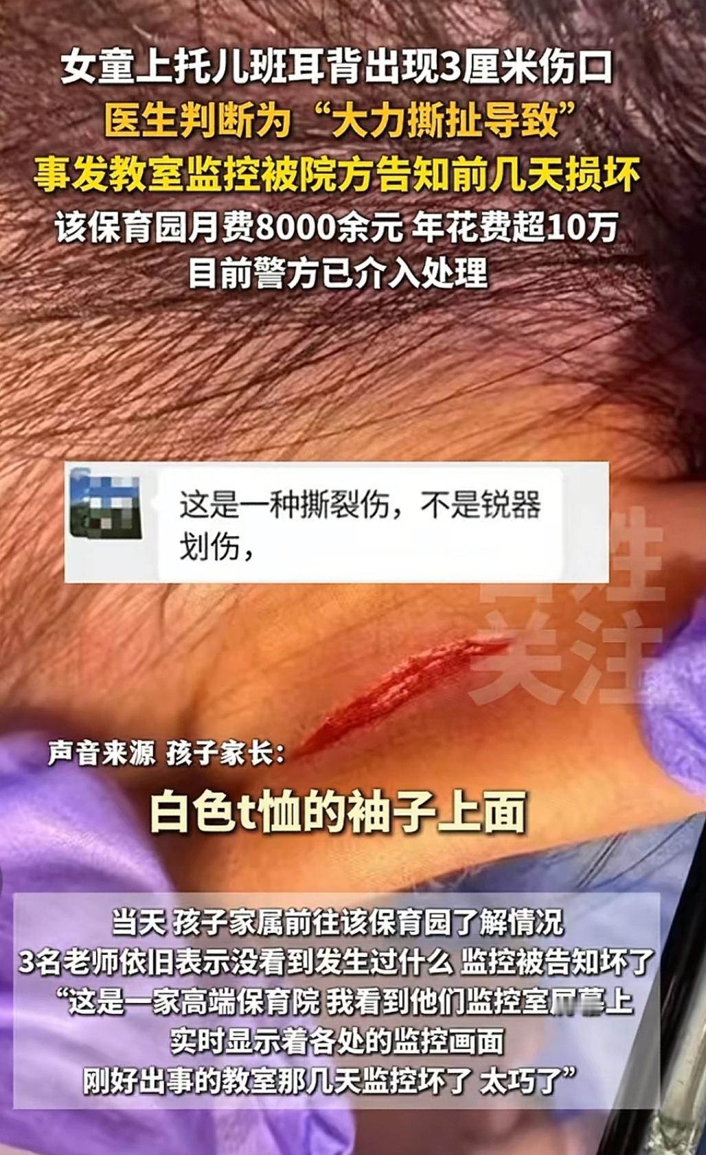 女童幼儿园被大力撕扯导致耳背撕裂，幼儿园以监控坏了为由唐塞事故原因，合理吗？
