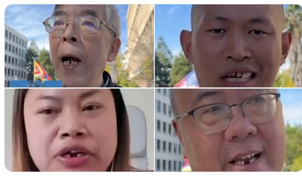 为什么这些大殖子去了美国后，
门牙都掉光了，这是怎么回事？
是被人打掉的吗？