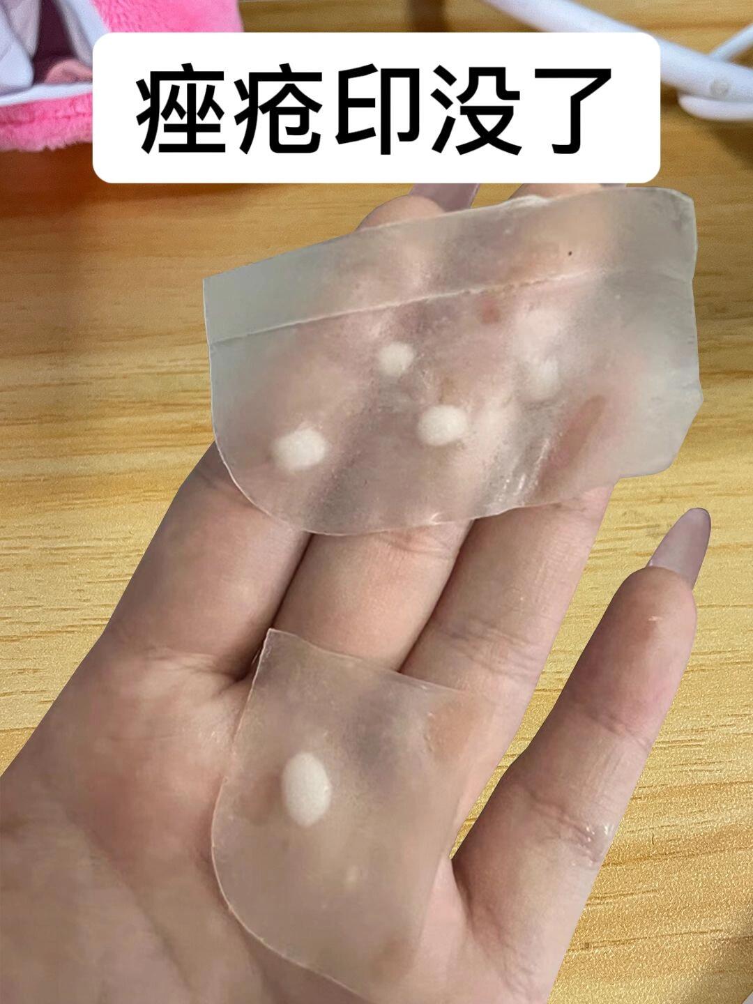 绝对不删‼️痤疮痘印一定要看，早看少受罪