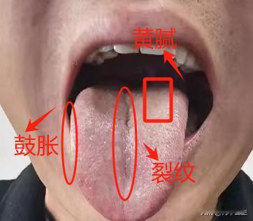 下焦湿热肝火旺，再不注意我怕你以后会后悔啊

今天看诊了这样一位患者，年纪不大，