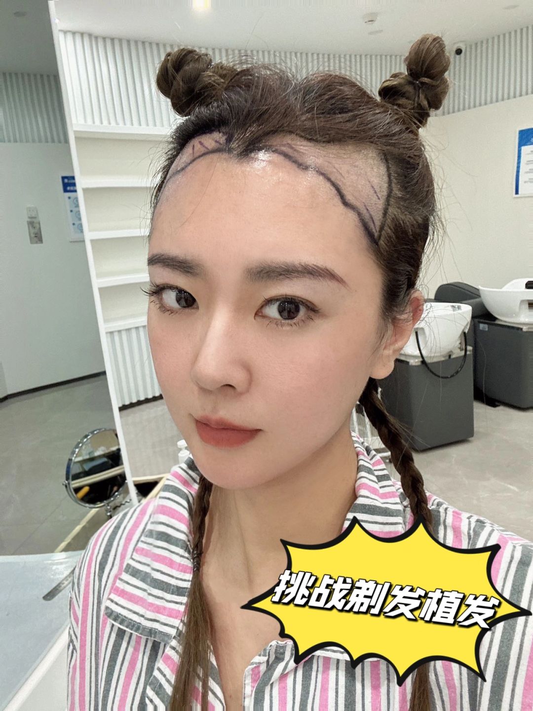 不会只有我一个人有勇气做剃发植发吧？