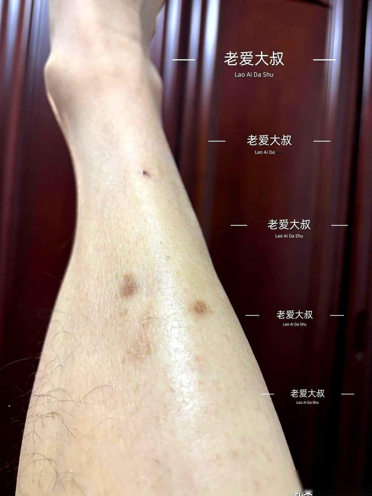 我就是从脚开始烂，才回过头去看腿上那个不起眼的小黑点。

那天下班脱袜子，鼻子里