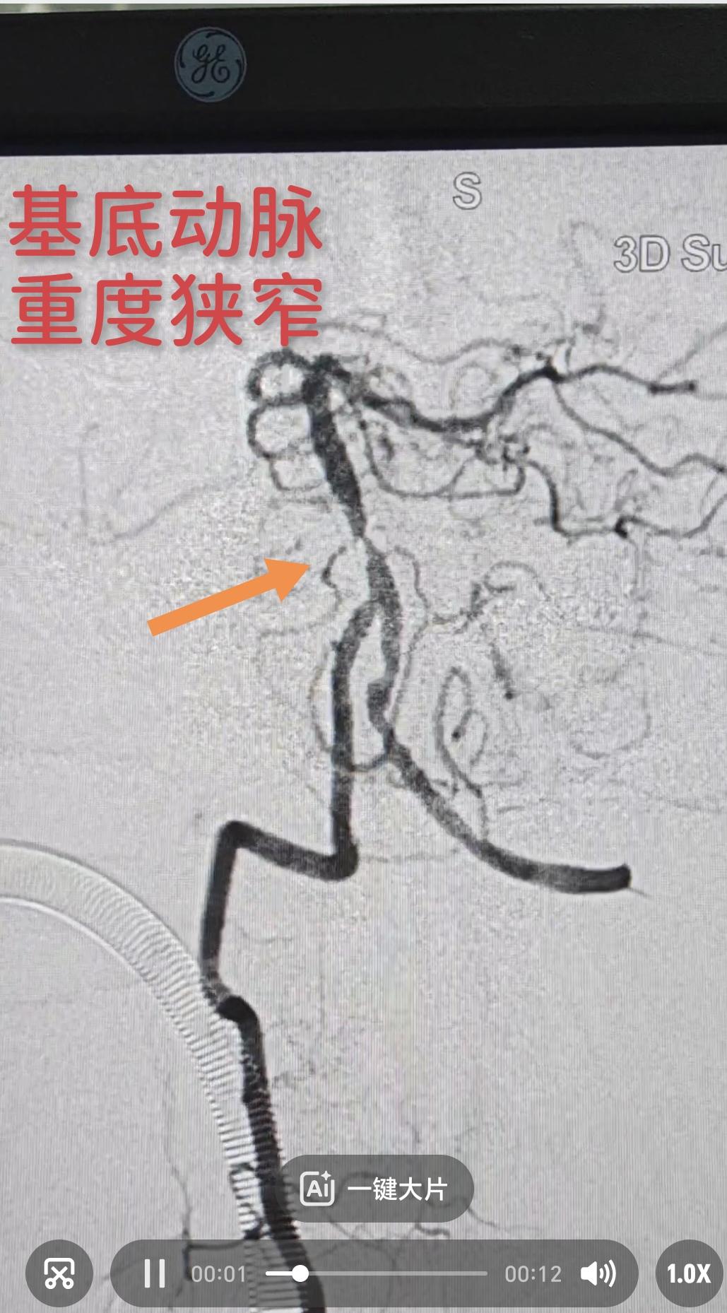 基底动脉，这条位于脑干腹侧的“生命主干道”，最窄处犹如发丝。在DSA的...