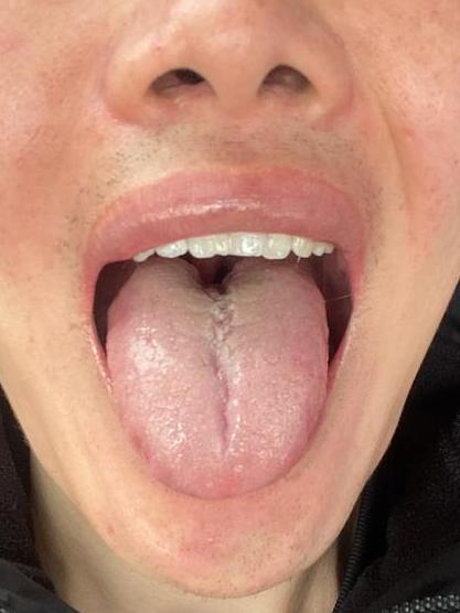 男人的专属舌象！“开裂舌”，裂纹从舌中裂到舌根
最痛苦的表现为：有心无力[伤心]